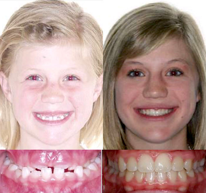 Invisalign Case