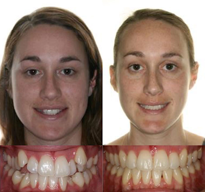 Invisalign Case