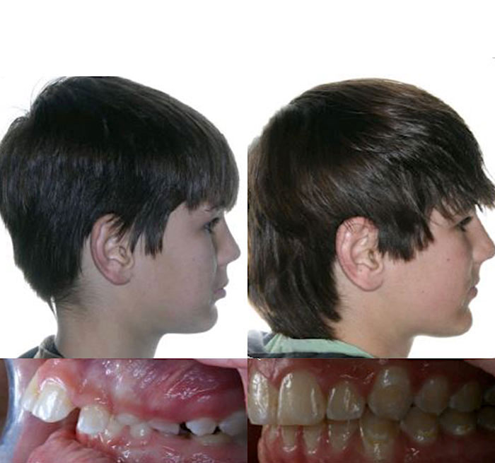 Invisalign Case